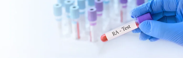 Factor Reumatoide